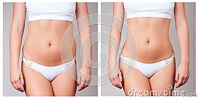 Female body before and after treatment. Plastic surgery. Stock Photo