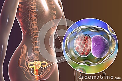 Female chlamydiosis, medical concept Cartoon Illustration