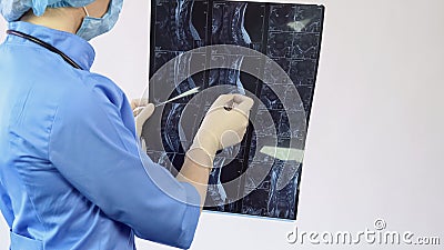 Female doctor analyzing patient spine bones x-ray, back pain treatment, hospital Stock Photo