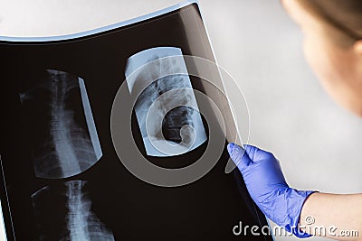 Female doctor examining X-ray film scan thoracic. Concept of medical service, diagnosis and treatment. Scoliosis or Stock Photo