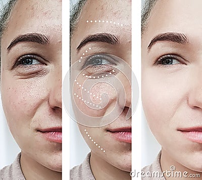 Female eyes wrinkles effect therapy difference removal before and after treatments patient Stock Photo