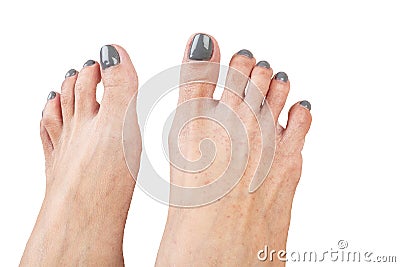 Female feet with eczema infect, isolated on white background, cl Stock Photo