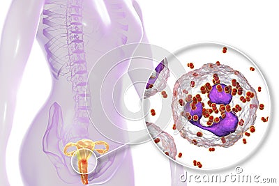 Female gonorrhea, medical concept Cartoon Illustration