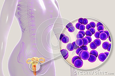 Female gonorrhea, medical concept Cartoon Illustration