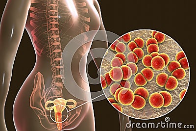 Female gonorrhea, medical concept Cartoon Illustration