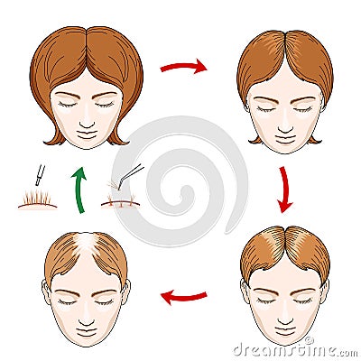 Female hair loss and transplantation icons Vector Illustration