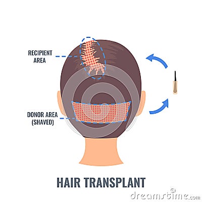 Female hair treatment with FUE transplantation method Vector Illustration