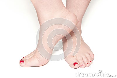 Female hairy legs with old pedicure Stock Photo