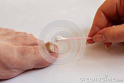 The female hand applies a cotton swab cream to the toenail affected by the fungus. Stock Photo
