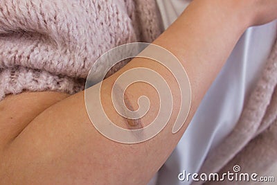 Female hand with thermal burn of the skin. Domestic injury during ironing or cooking Stock Photo