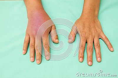 Female hands one swollen and inflamed Stock Photo