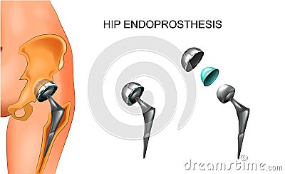 Female hip and hip prosthesis. Vector Illustration