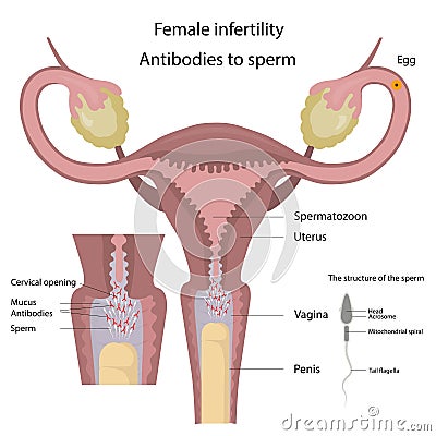 Female infertility. Antibodies to sperm. Vector Illustration