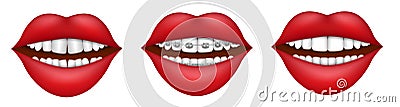 Female mouth with dental braces, crooked and straight teeth Vector Illustration