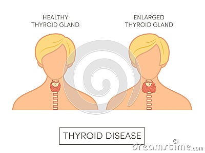 Female with normal and enlarged thyroid gland Cartoon Illustration
