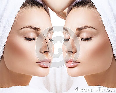 Female nose before and after cosmetic surgery. Stock Photo