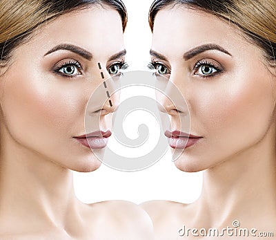 Female nose before and after cosmetic surgery. Stock Photo