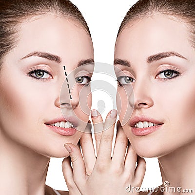 Female nose before and after cosmetic surgery. Stock Photo