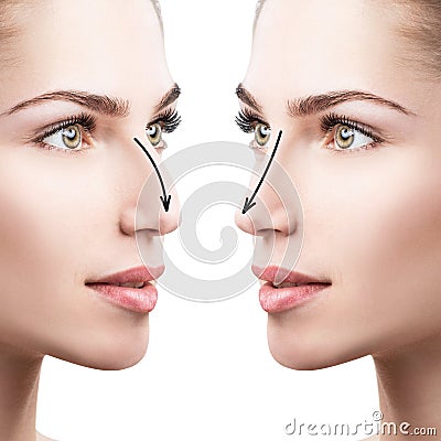Female nose before and after cosmetic surgery. Stock Photo