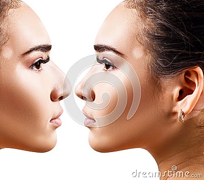 Female nose before and after cosmetic surgery. Stock Photo