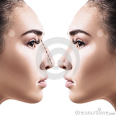 Female nose before and after cosmetic surgery. Stock Photo