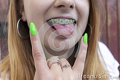 Female teeth with green dental braces. Stock Photo