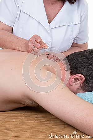 Female Therapist doing acupuncture to a man back Stock Photo