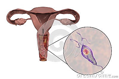 Female trichomoniasis, illustration showing vaginitis and close-up view of Trichomonas vaginalis parasite Cartoon Illustration