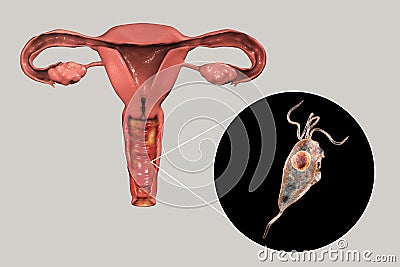 Female trichomoniasis, illustration showing vaginitis and close-up view of Trichomonas vaginalis parasite Cartoon Illustration