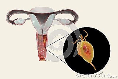 Female trichomoniasis, illustration showing vaginitis and close-up view of Trichomonas vaginalis parasite Cartoon Illustration