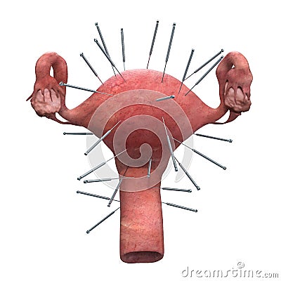 Female uterus with acupuncture needles. Acupuncture treatment of uterus concept, 3D rendering Stock Photo