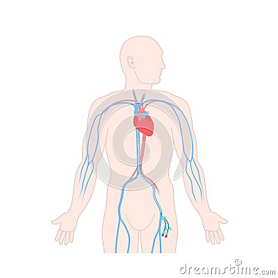 Femoral central line venous catheter on male body Vector Illustration