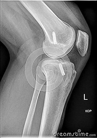 Femoral interference screw, Anatomical reconstruction of anterior cruciate ligament of the knee Stock Photo