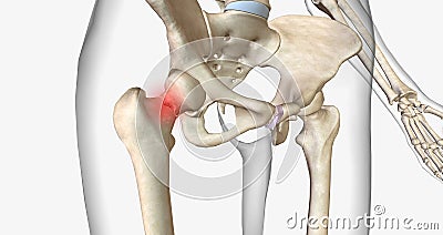 A femoral neck fracture is a type of hip fracture that occurs in the section of the femur closest to the pelvis Stock Photo