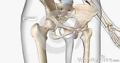 A femoral neck fracture is a type of hip fracture that occurs in the section of the femur closest to the pelvis Stock Photo