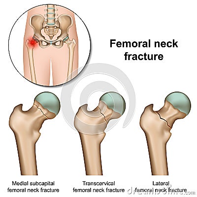 Femoral neck fractures medical illustration on white background Cartoon Illustration