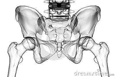 Femur bone affected by Legg-Calve-Perthes Disease, a childhood hip disorder, 3D illustration Cartoon Illustration