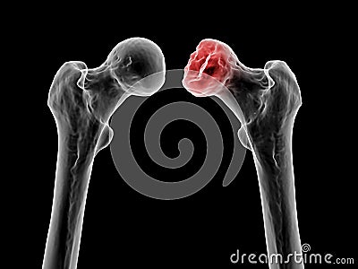 Femur bone affected by Legg-Calve-Perthes Disease, a childhood hip disorder, 3D illustration Cartoon Illustration