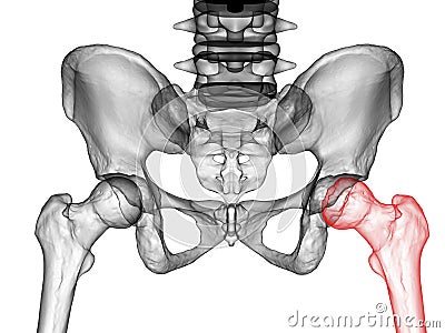 Femur bone affected by Legg-Calve-Perthes Disease, a childhood hip disorder, 3D illustration Cartoon Illustration