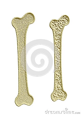 Femur bone cut in half showing normal bone density and osteoporosis Stock Photo