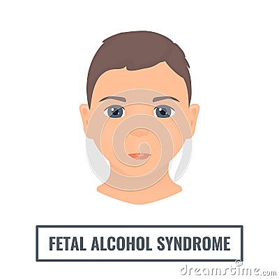 Fetal alcohol syndrome facial features in a child Vector Illustration