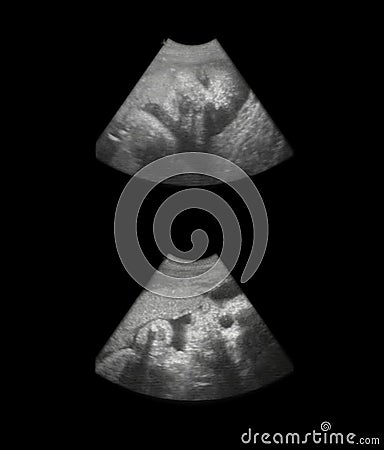 Fetus sonogram - 8 month Stock Photo
