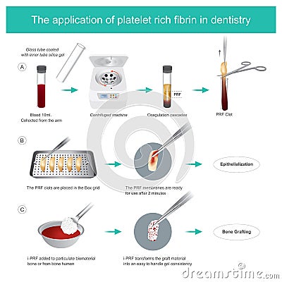 Fibrin-rich platelets PRF in dentistry. Development of biologically active surgical additives to control inflammation and speed Stock Photo