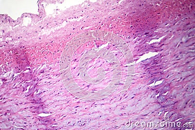 Fibrinoid necrosis in a vessel wall, light micrograph Stock Photo