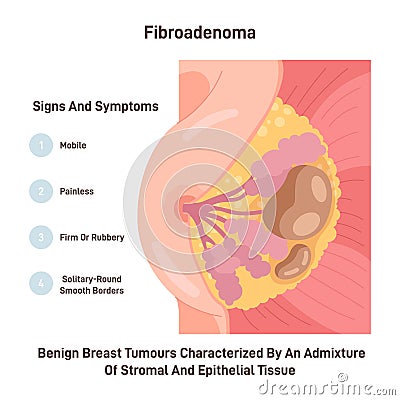 Fibroadenoma. Neoplasm in female chest. Benign breast tumour Vector Illustration