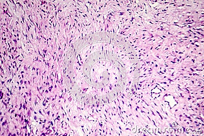 Fibroma, a benign tumour of fibrous tissue Stock Photo