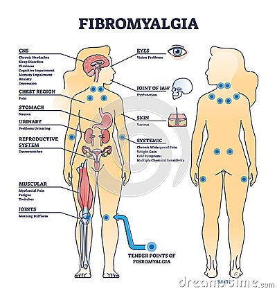 Fibromyalgia as musculoskeletal pain disorder tender points outline diagram Vector Illustration