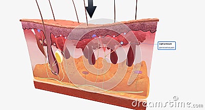 With fibromyalgia, nerves become hypersensitive to external stimuli, a change known as central sensitization Stock Photo