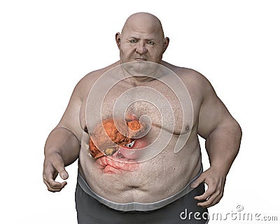 Fibrotic liver in obese man, 3D illustration. Concept of obesity and inner organs diseases Cartoon Illustration