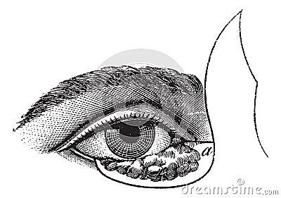 Fig. 177. Blepharoplasty by the method of Blasius, vintage engraving Vector Illustration